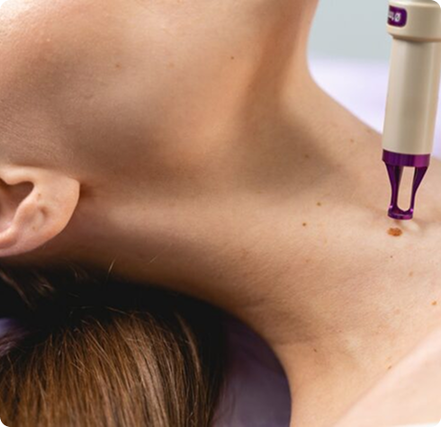 Mole Removal