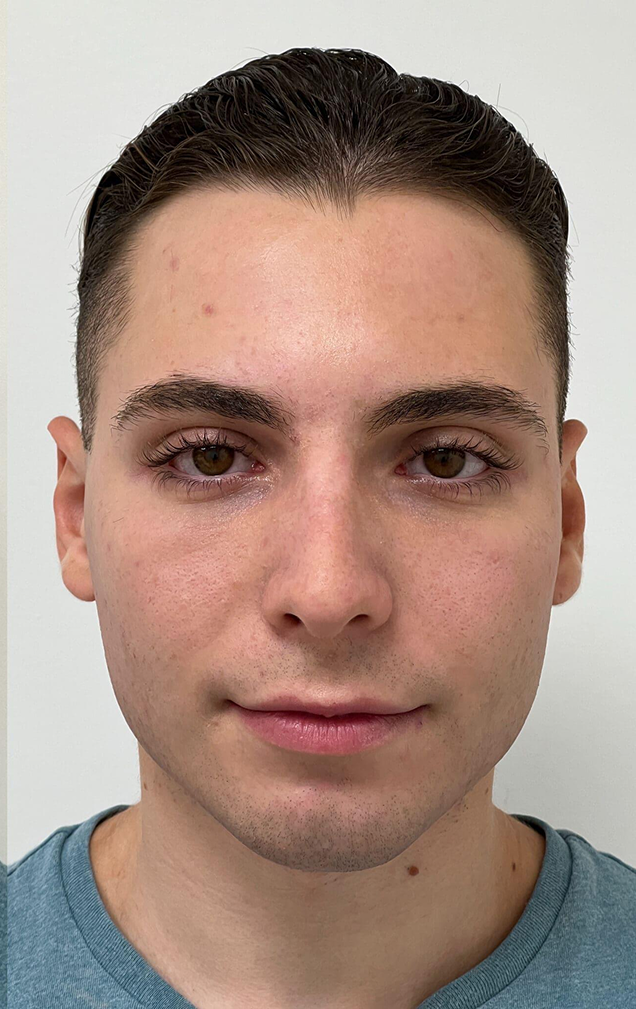 After Treatment