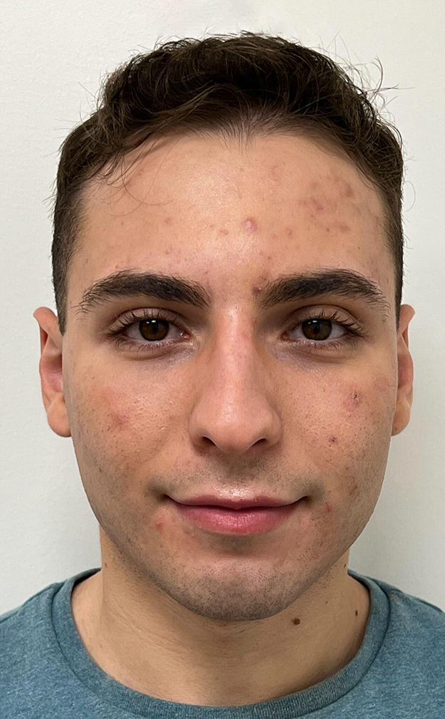 Before Treatment