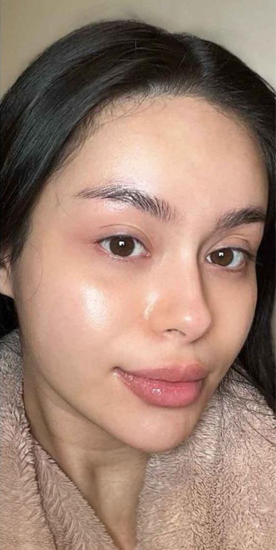 After Treatment
